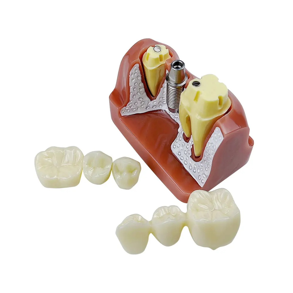 4 Vezes De Implante De Dentes Modelo Para Dentista Demonstração Do Aluno Módulo De Ensino Estudo Da Ciência Médica Prática De Doenças Modelo Imagem 1
