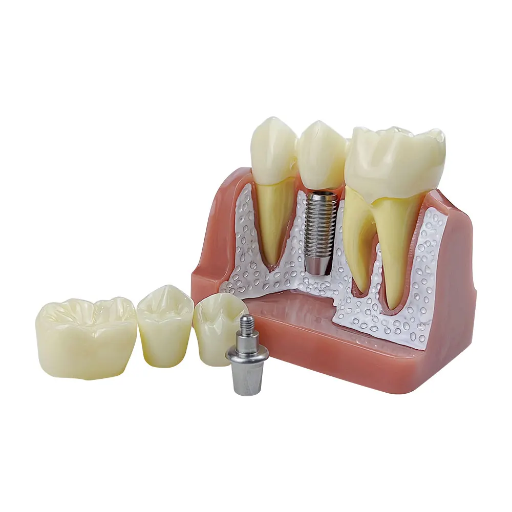 4 Vezes De Implante De Dentes Modelo Para Dentista Demonstração Do Aluno Módulo De Ensino Estudo Da Ciência Médica Prática De Doenças Modelo Imagem 2