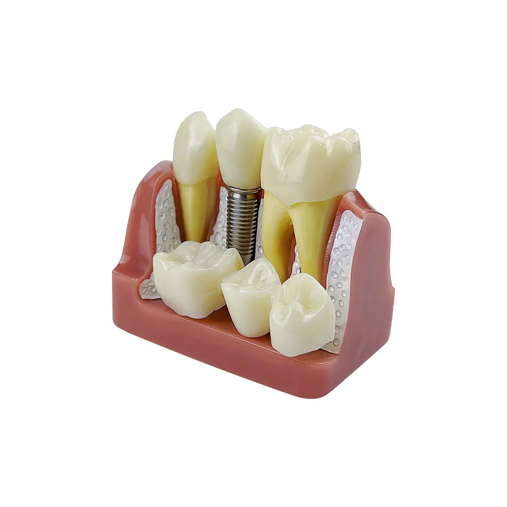 4 Vezes De Implante De Dentes Modelo Para Dentista Demonstração Do Aluno Módulo De Ensino Estudo Da Ciência Médica Prática De Doenças Modelo Imagem 3