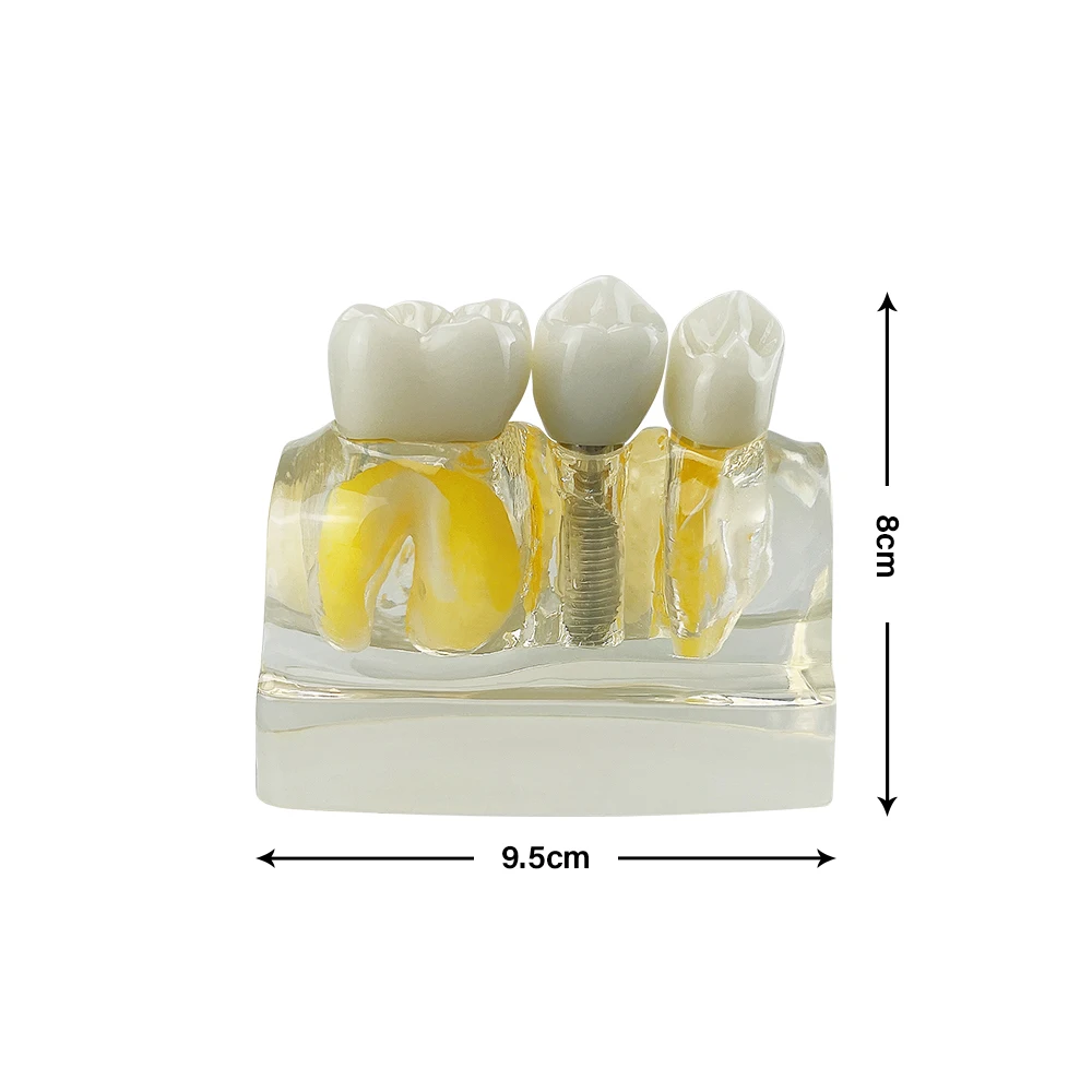 4 Vezes De Implante De Dentes Modelo Para Dentista Demonstração Do Aluno Módulo De Ensino Estudo Da Ciência Médica Prática De Doenças Modelo Imagem 5