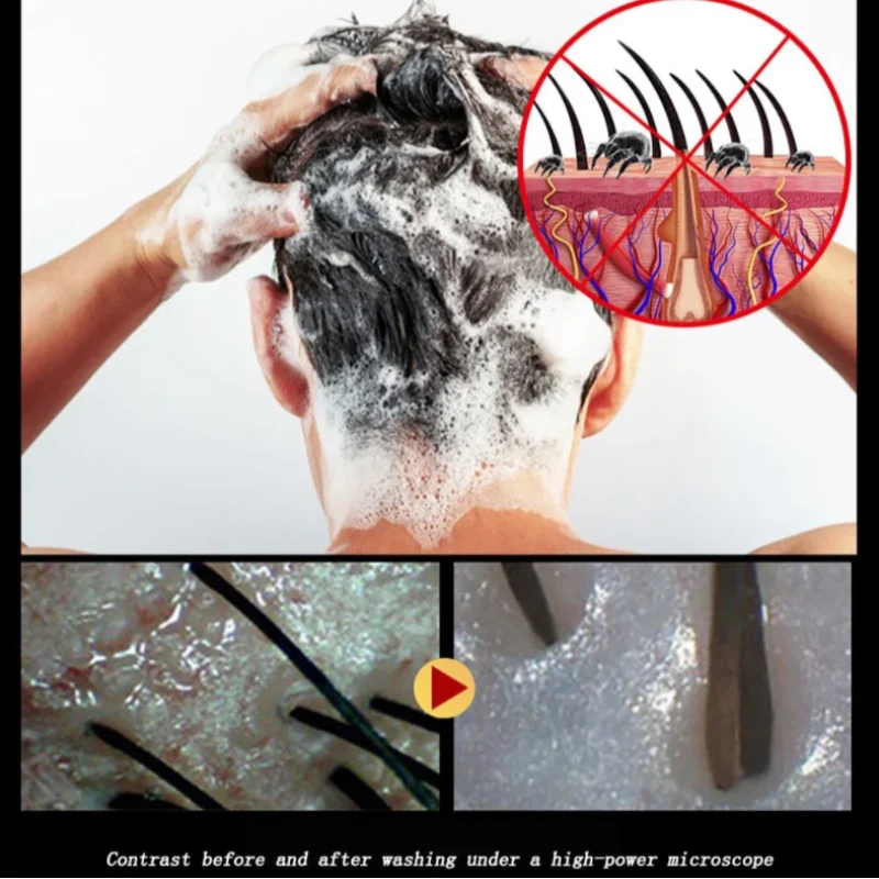 Produto do Cuidado do cabelo do couro Cabeludo Folículo de Cabelo Shampoo anti-Bacteriano, Anti-coceira Ácaros de Controle de Óleo Psoríase no couro Cabeludo e Xampu de Limpeza Imagem 3