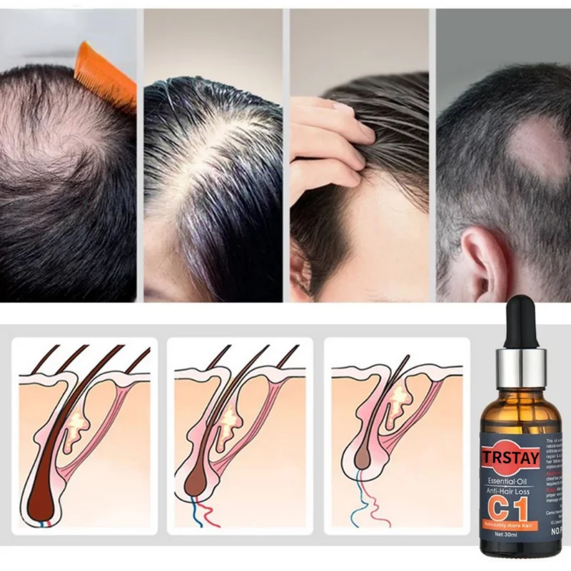 Spray de cabelo PRODUTOR de Produtos Anti-queda de cabelo o Óleo Essencial de Crescimento de Soro de Crescimento do Cabelo para Homens Imagem 1
