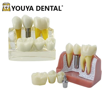 4 Vezes De Implante De Dentes Modelo Para Dentista Demonstração Do Aluno Módulo De Ensino Estudo Da Ciência Médica Prática De Doenças Modelo