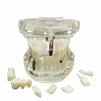 A Restauração dentária de Dentes Modelo Transparente Implante Doença Dentes Modelo com Ponte Destacável Dentes Doença de Ensino do Estudo do Modelo